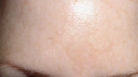 forehead-post-apothederm-br