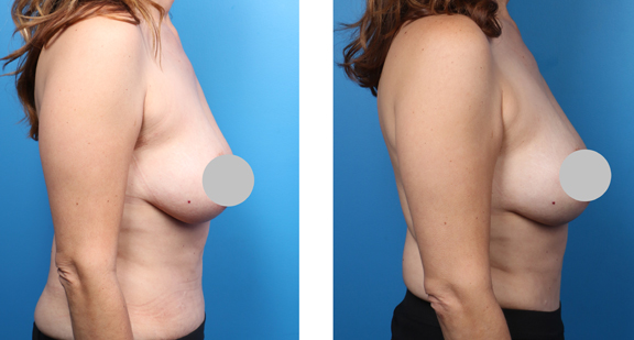 thermibreast-profile